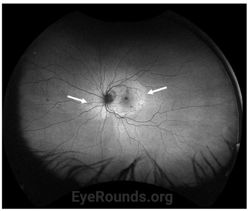 Fundus autofluorescence (FAF) image of the left eye at initial visit demonstrating hyperautofluorescence in the regions corresponding to placoid whitening on examination (arrows)