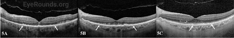 OCT macula of the left eye at the initial visit (A), 3-week follow-up (B), and 4-month follow-up (C)