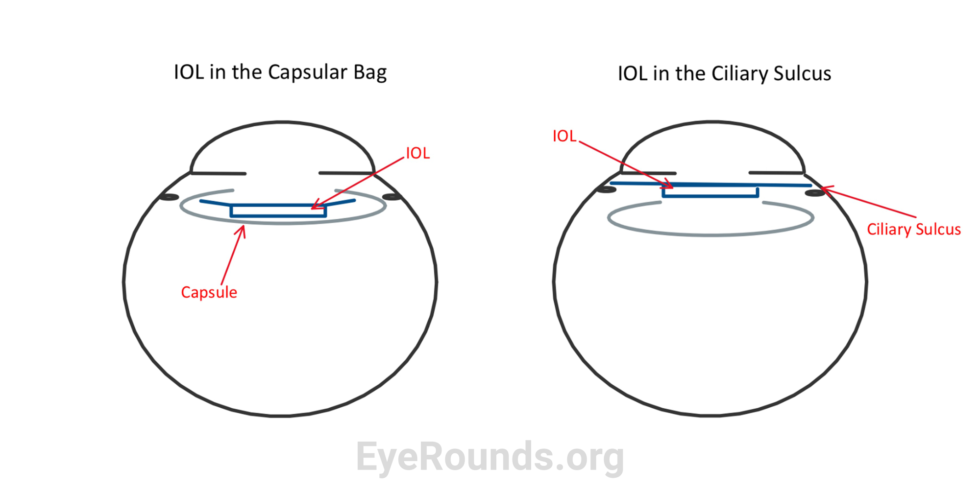 Position of IOL in the ciliary sulcus versus position in the capsular bag