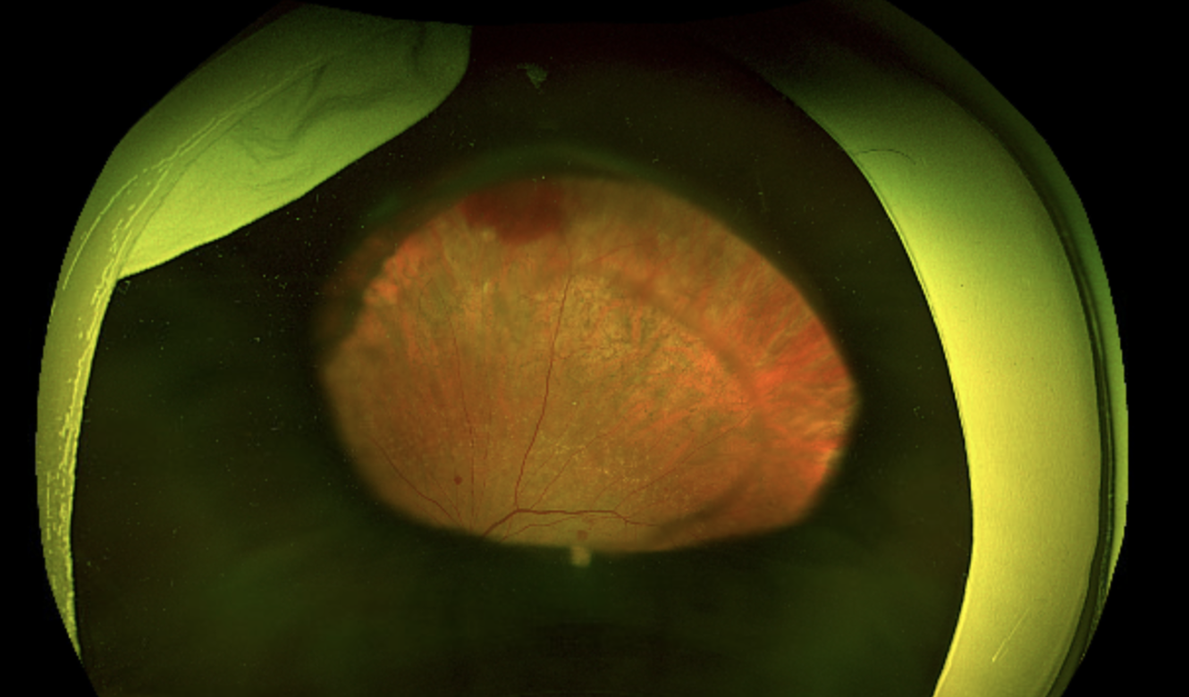 A color fundus photograph of the left eye focused more superiorly demonstrated peripheral subretinal hemorrhage.