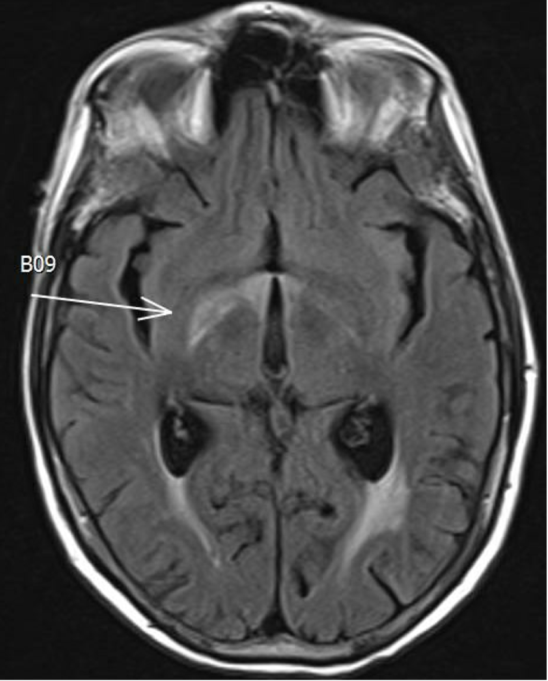 Axial post-gadolinium T1-weighted MRI (left) showed bilateral enhancement within the optic nerves anterior to the chiasm (arrows). Axial T2-FLAIR sequence showed an abnormality likely related to edema secondary to the enhancing foci (right). The findings were consistent with radiation optic neuropathy.