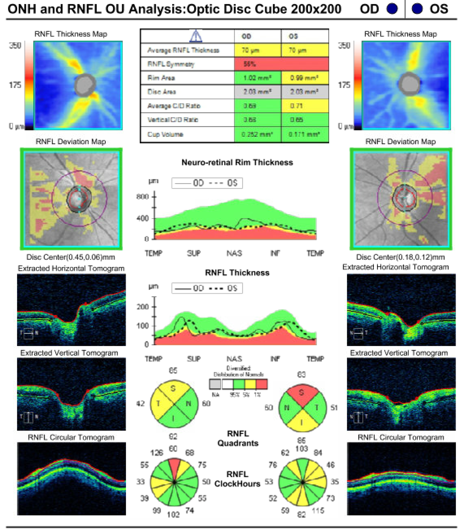 Optical coherence tomography (OCT) of the optic nerve head. Reduced retinal nerve fiber layer (RNFL) thickness in both eyes with an average RNFL thickness of 70 μm OD and 70 μm OS. 
