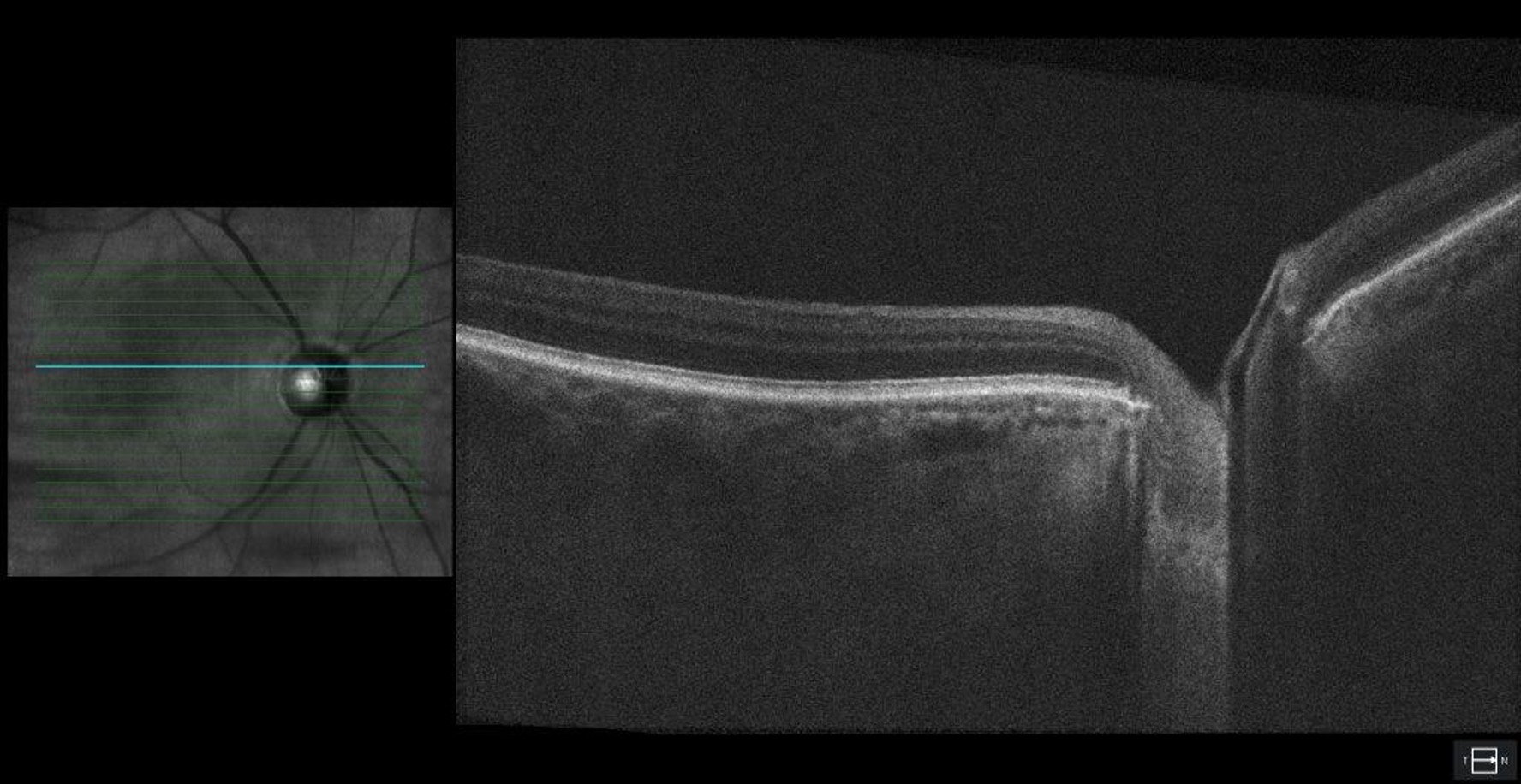 Optical coherence tomography (OCT) of the optic nerve head showing severe dropout of the ganglion cell complex (GCC) in right eye.