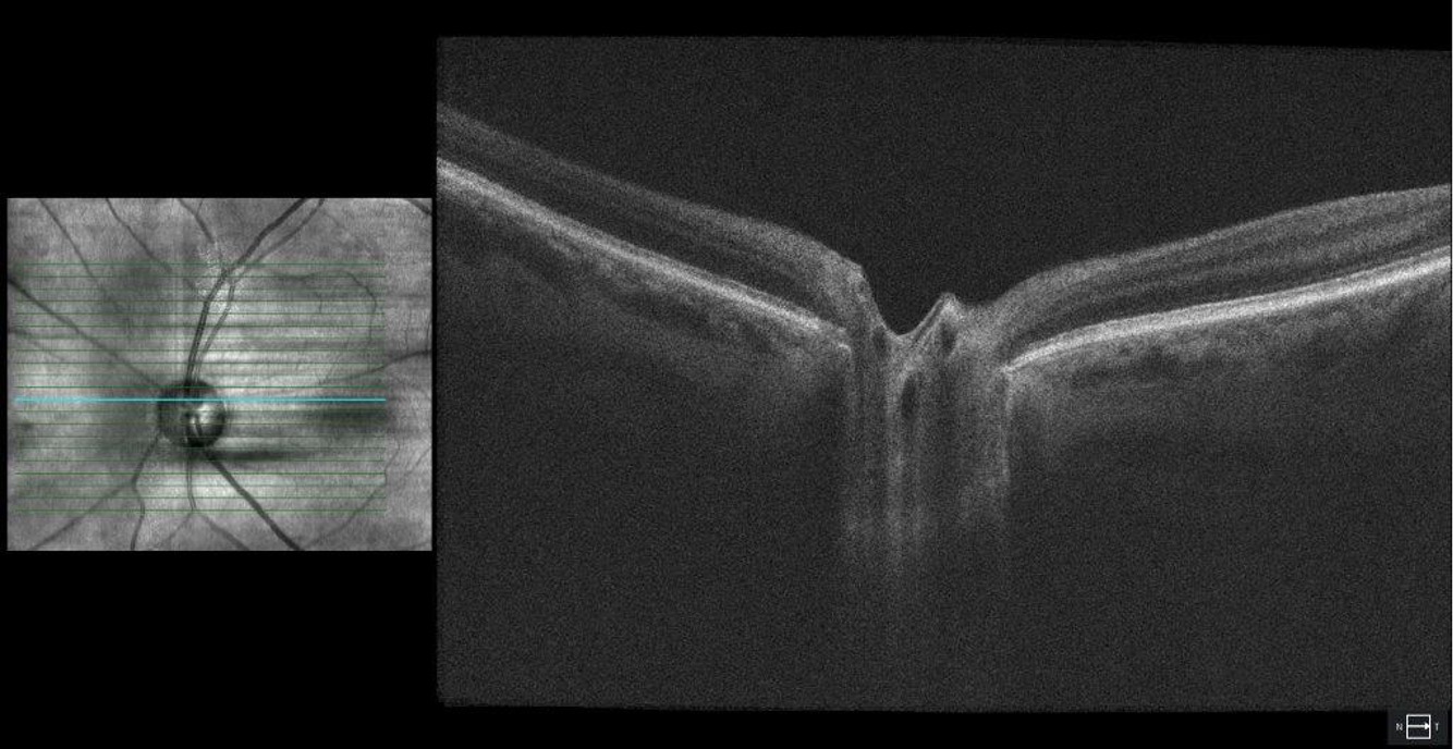 Optical coherence tomography (OCT) of the optic nerve head showing severe dropout of the ganglion cell complex (GCC) in left eye