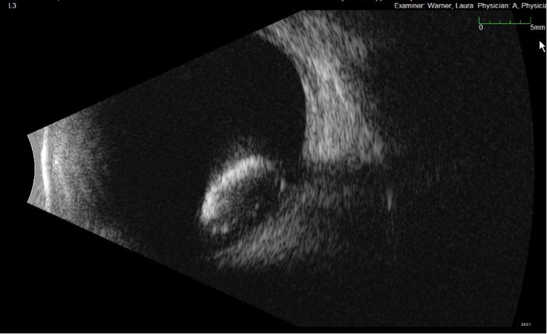 Fluorescein angiography of the right eye at 1 minute, 28 seconds showing segmental arterial wall hyperfluorescence in the superior arcade, and segmental arterial nonperfusion superotemporally