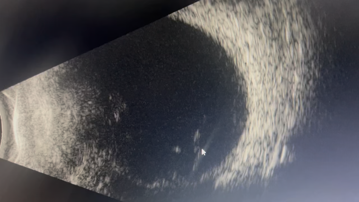 Fluorescein angiography of the left eye at 47 seconds showing nonperfusion from BRAO within the superior aspect of the macula with multiple foci of segmental arterial wall hyperfluorescence superior to the disc and along the inferior arcade.