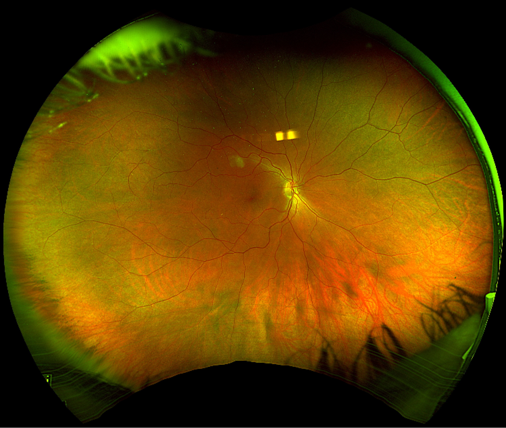 Optos ultra-widefield pseudocolor image of the right eye demonstrating a twig BRAO along superotemporal arcade within the macula. There are Gass plaques visible in the superotemporal periphery. 