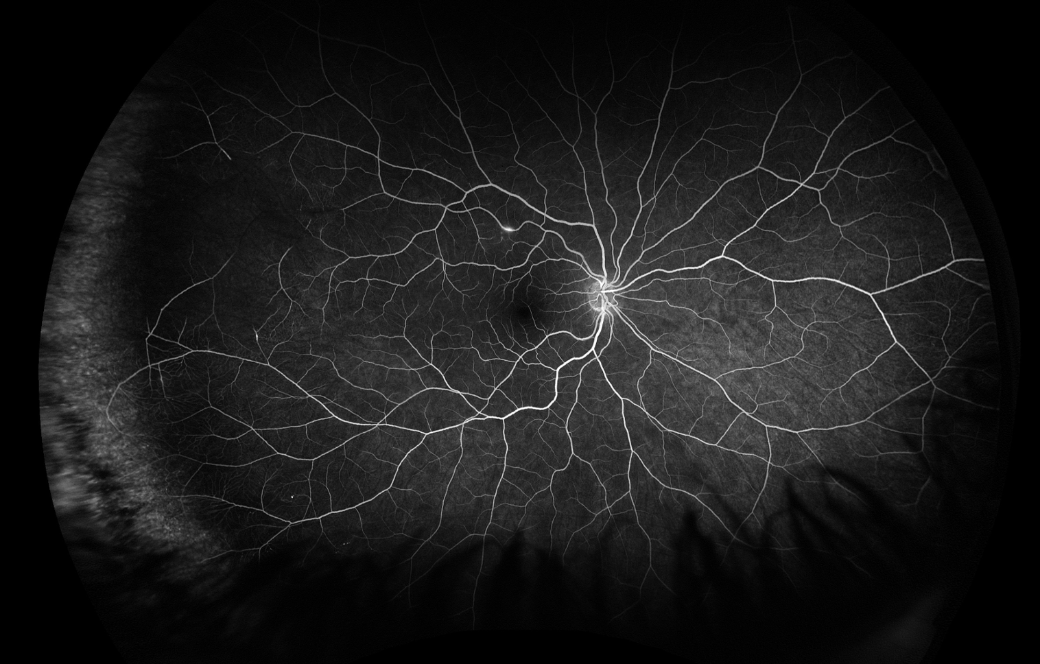 Fluorescein angiography of the right eye at 1 minute, 28 seconds showing segmental arterial wall hyperfluorescence in the superior arcade, and segmental arterial nonperfusion superotemporally