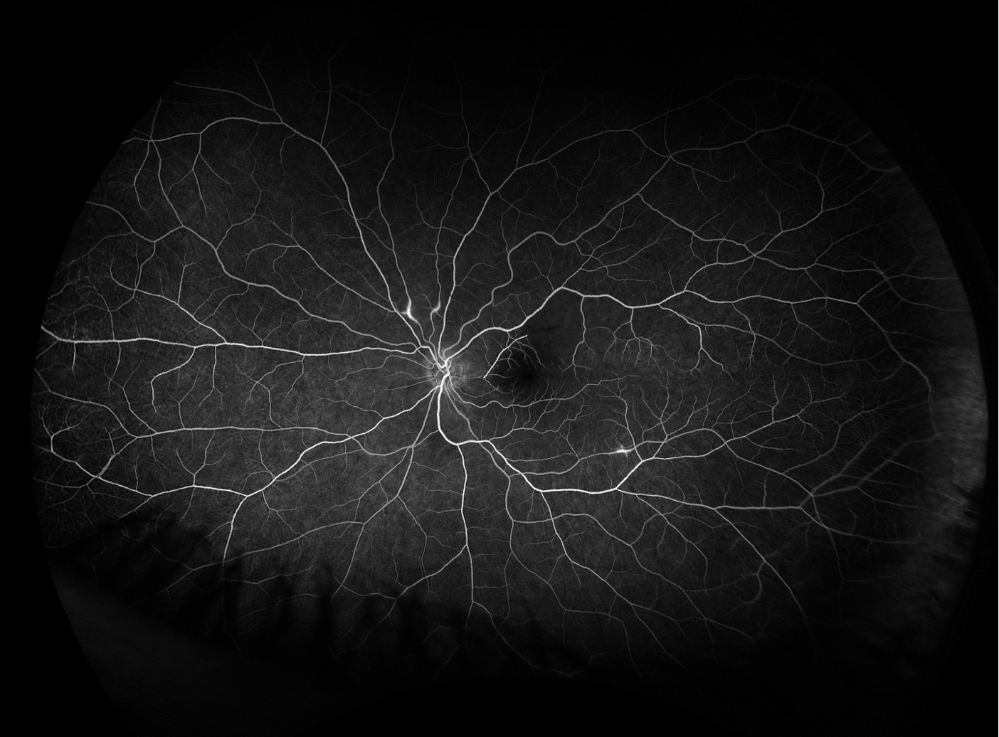 Fluorescein angiography of the left eye at 47 seconds showing nonperfusion from BRAO within the superior aspect of the macula with multiple foci of segmental arterial wall hyperfluorescence superior to the disc and along the inferior arcade.