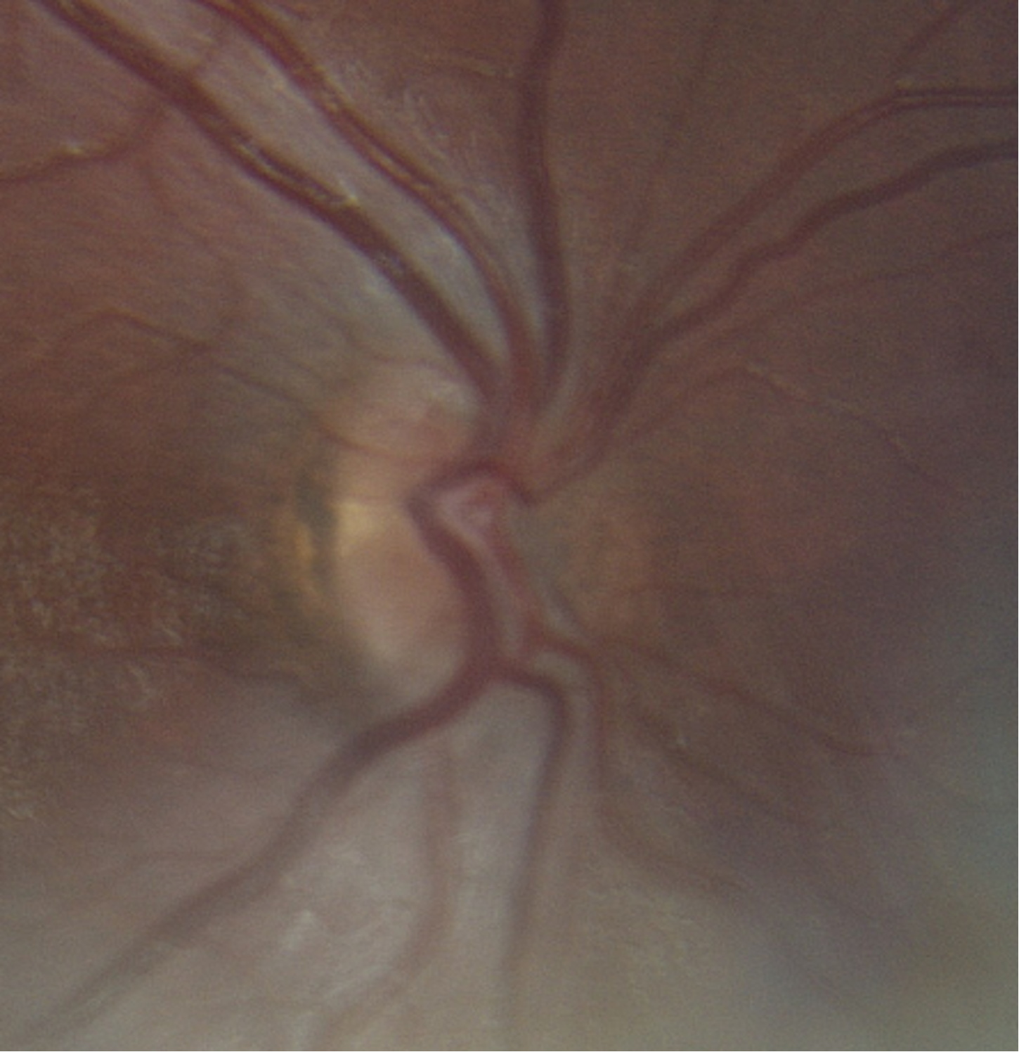 Fundus photograph of the patient demonstrating binasal optic nerve hypoplasia which corresponds to the temporal field defect in the Goldmann visual field. Right eye (OD, left panel) 