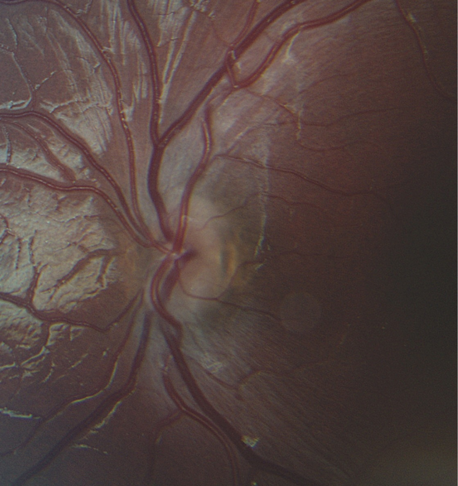 Fundus photograph of the patient demonstrating binasal optic nerve hypoplasia which corresponds to the temporal field defect in the Goldmann visual field. Left eye (OS, right panel). 
