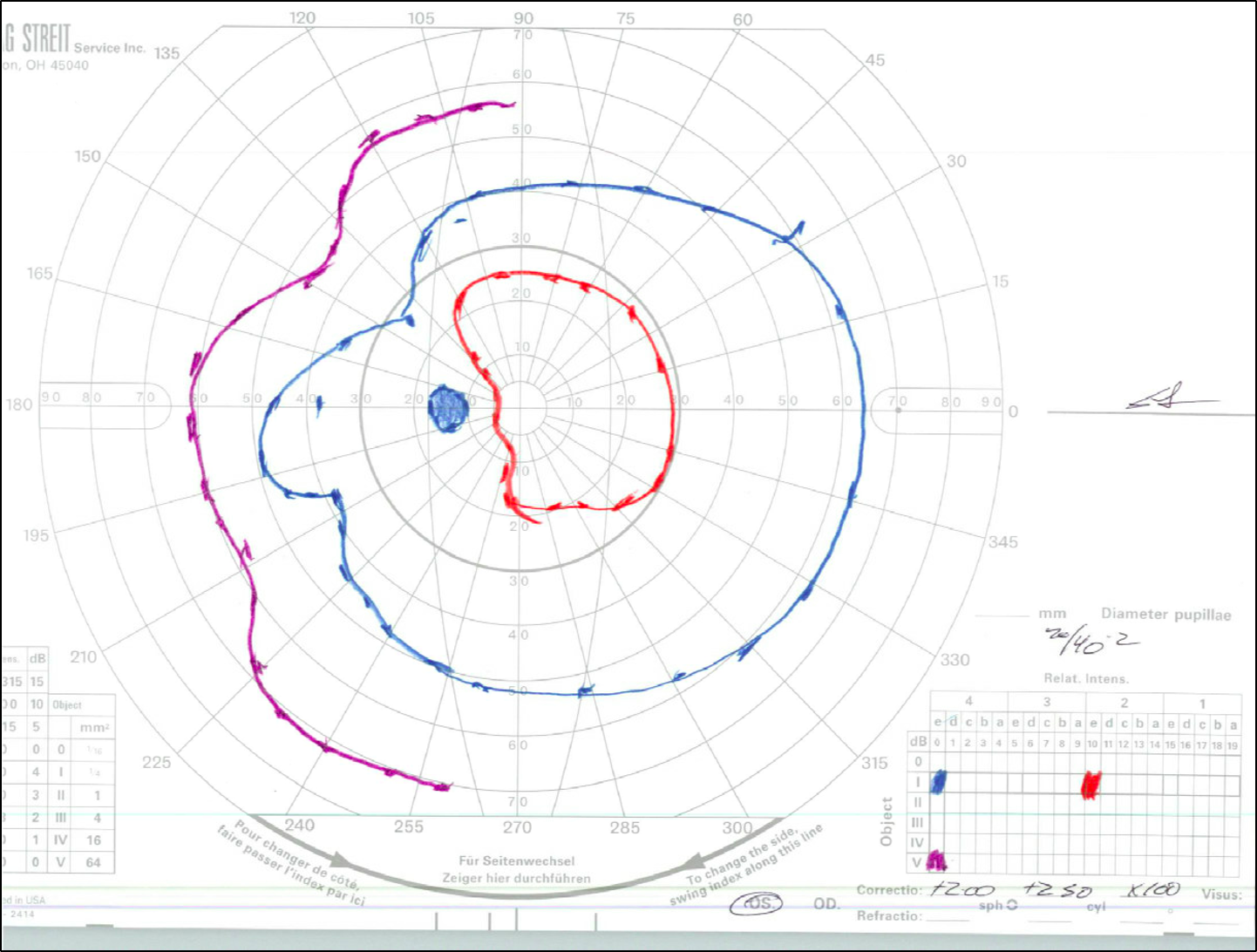 Goldmann Visual Field testing demonstrating bitemporal constriction of the I2e isopter in the left eye (OS, left panel) 