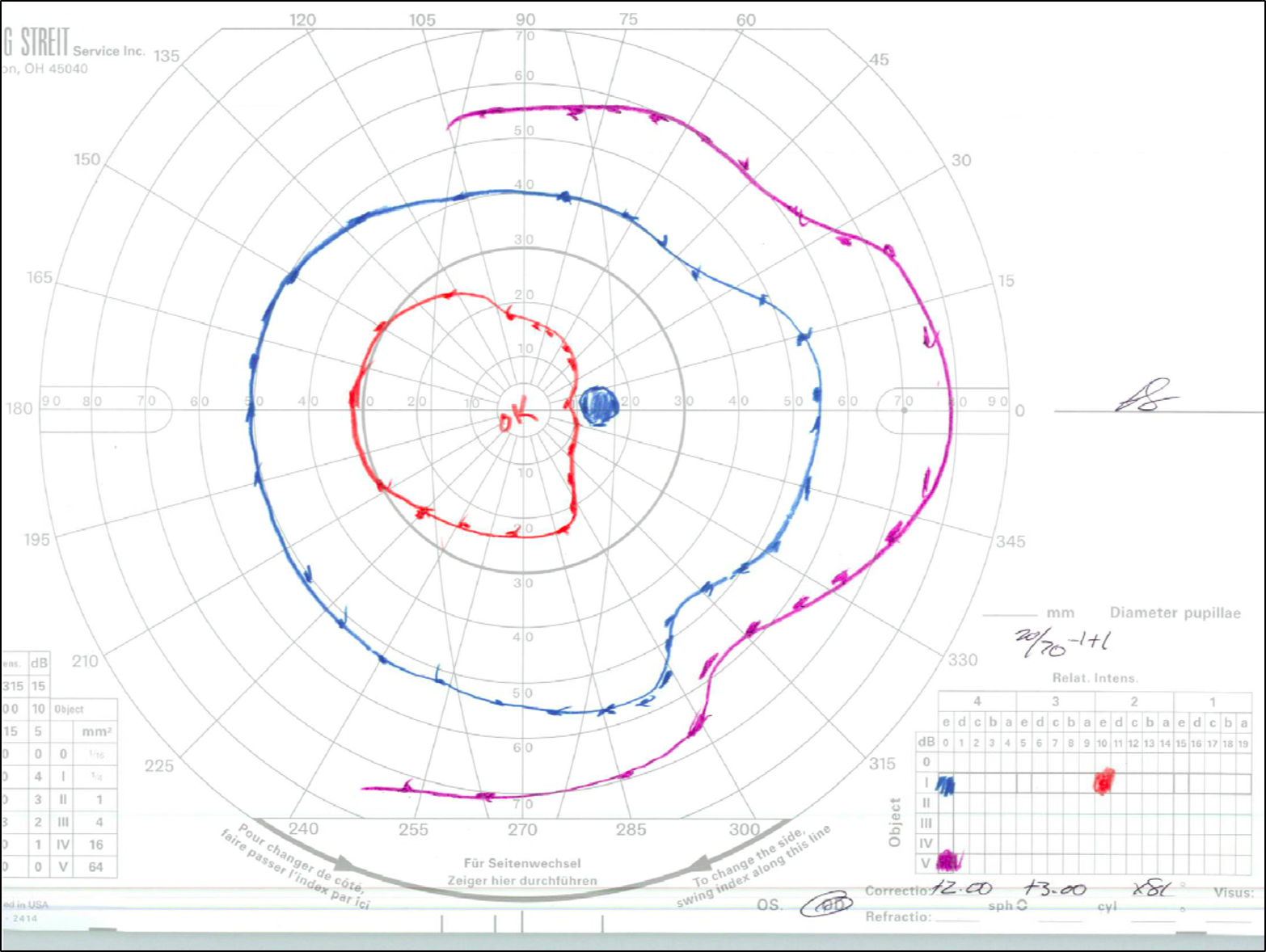 Goldmann Visual Field testing demonstrating bitemporal constriction of the I2e isopter in the right eye (OD, right panel).