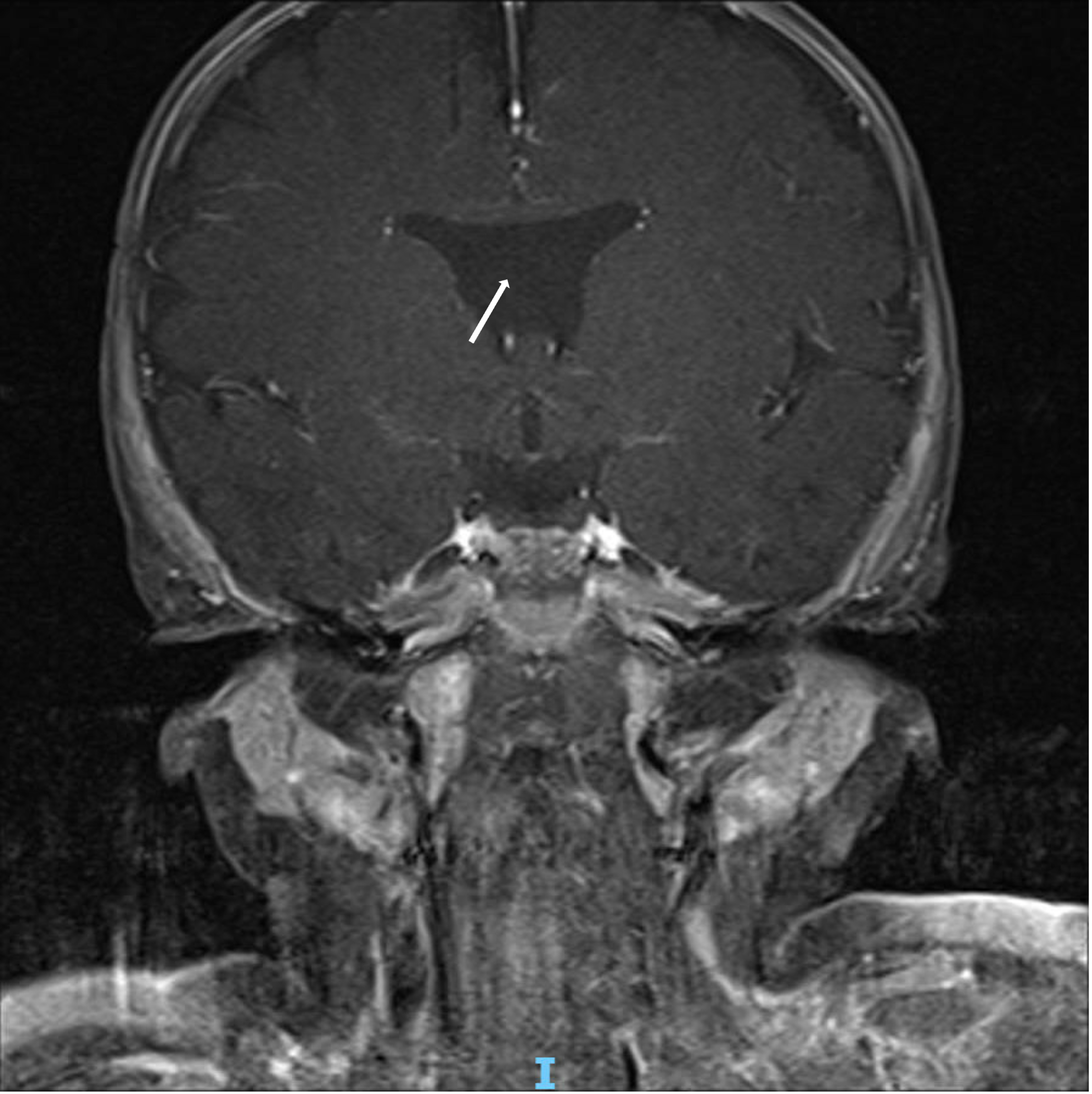 T1-weighted fat-suppressed (FS) post-contrast MRI demonstrating absence of the septum pellucidum (white arrow). (A) Coronal T1 FS post-contrast image. 