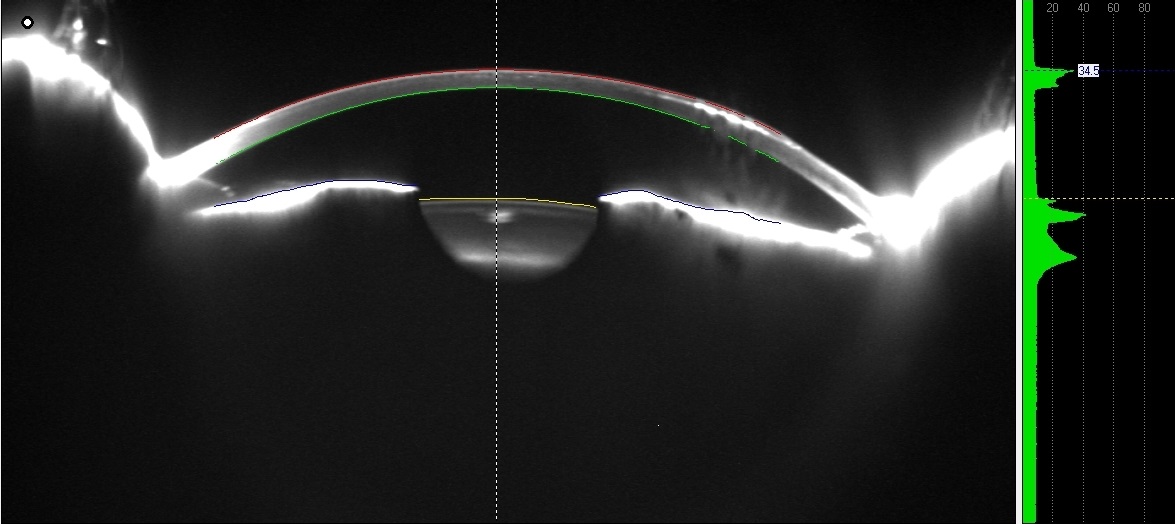ZEISS Pentacam densitometry of right eye. Note increased reflectivity and artifact production due to epithelial ingrowth.