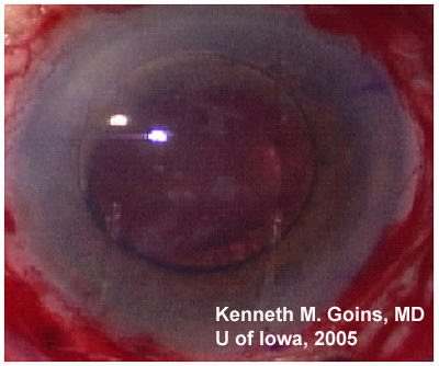 Slit lamp view of the right eye showing corneal edema and an anterior chamber intraocular lens.