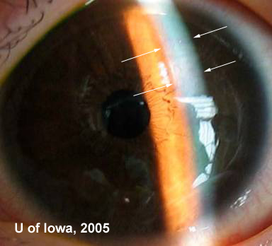 Primary Congenital Glaucoma