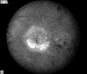 flurescein image, OS, ten weeks after initial infection. The vitreous space is clear and retinal hemorrhages have resolved. The retina had atrophy and occult choroidal neovascularization.
