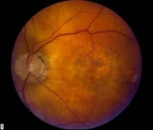 Fundus image, OS, ten weeks after initial infection. The vitreous space is clear and retinal hemorrhages have resolved. The retina had atrophy and occult choroidal neovascularization.