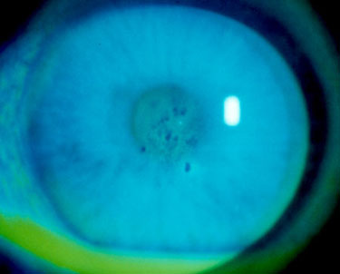 Fluorescein Staining of right eye, ophthalmic cases, keratoplasty, laser assisted keratoplasty, femtosecond laser, Fuchs endothelial dystrophy, top hat