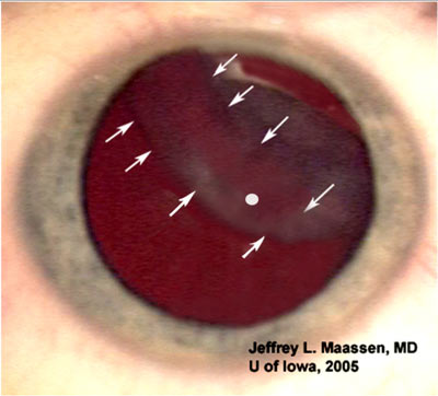 Traumatic cataract and anterior capsular tear