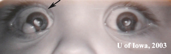 External image taken at 10 months of age demonstrates bilateral limbal dermoids at the temporal limbus of both eyes, (OD > OS). The black arrow indicates the site of right upper eyelid coloboma.