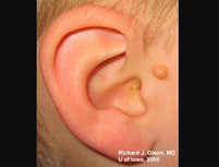Preauricular skin tag, right ear. The ear itself has no deformity or microtia. 