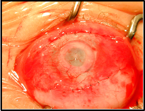 Appearance after Stage I procedure with conjunctival flap completed. 
