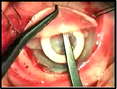 Stage I surgery - implantation of keratoprosthesis 