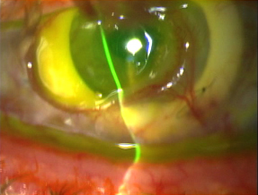 56-year-old male with history of ocular trauma, four failed PKPs with corneal melt shortly after AlphaCor implantation. 