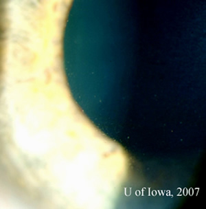 Slit lamp view, OS, focused on the cornea demonstrates fine keratic precipitates. 