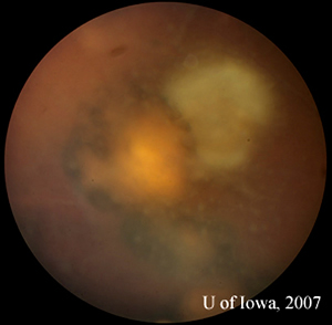 Close view of lesion, OS. A unifocal area of inflammation is seen adjacent to a chorioretinal scar. 