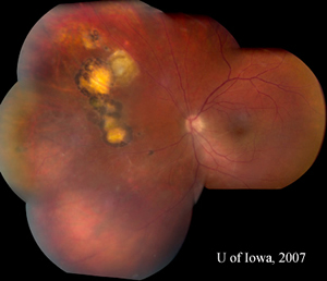July 2007 montage, OS, reveals reduced inflammation. A string of adjacent scars is evident, suggestive of multiple previous recurrences. 