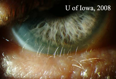 Distichiasis, close up showing 2 rows of lower eyelashes