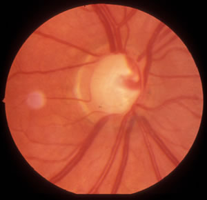 Juvenile Open Angle Glaucoma - Myocilin