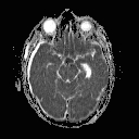 Figure 3B. MRI with ADC (apparent diffusion coefficient) showing corresponding area of hypointensity. This signifies infarction.