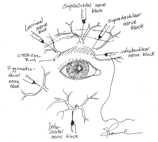 diagram of a dace showing Common Periorbital Nerve Blocks 
