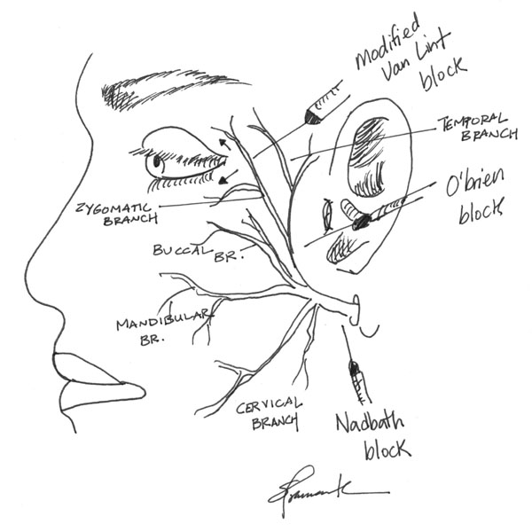 diagram of face showing Common Facial Nerve Blocks