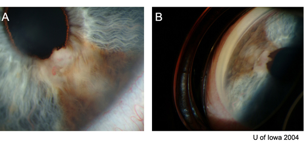 gonioscopy of iris melanoma