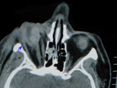 Axial CT Scan of Hit & Run Case 