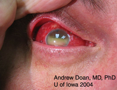 Eye injuries. Eye contusions, perforations and blows in the eye.