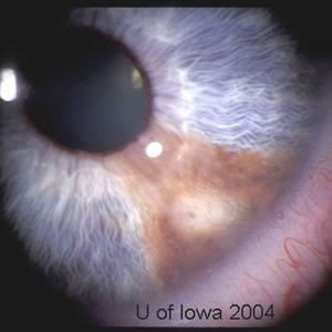 Iris Melanoma