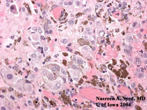 Nesting of Melanocytes