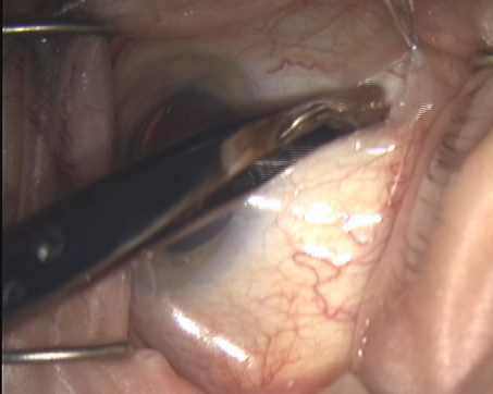 Figure 4: Button hole formed ~10 mm from the corneal limbus. 