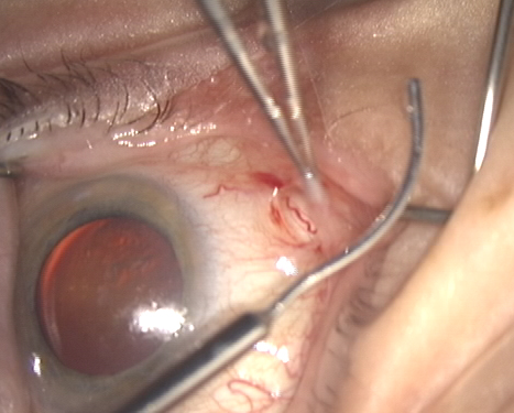 Figure 6: Lacrimal cannula