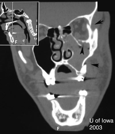Zygomatic maxillary complex (ZMC) Fracture 