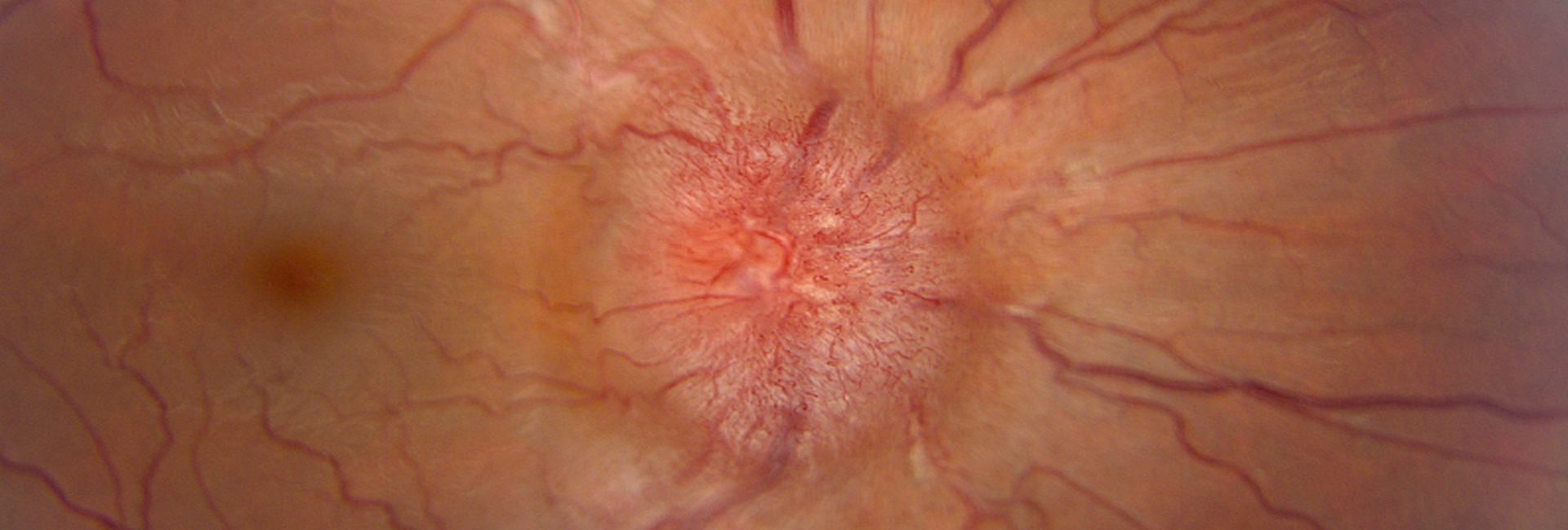 Grading Papilledema, image of grade 4 or 5 papilledema