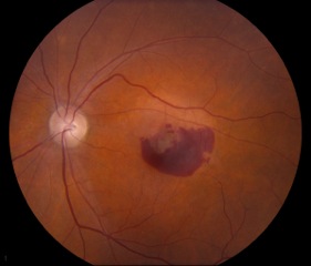 subretinal hemorrhage in the presence of wet AMD.