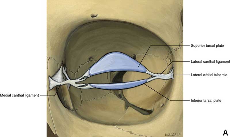 Lateral canthal tendon attaches the the tarsal plates of the eyelid to the periosteum at the lateral orbital tubercle. The orbital compartment is a closed compartment and the walls are comprised of 7 bones, including the ethmoid, lacrimal, sphenoid, frontal, maxillary, zygomatic, and palatine bones. (Reprinted with permission from Elsevier.)
