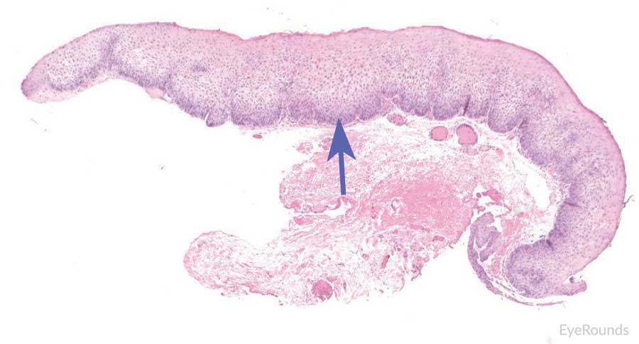 Invasive conjunctival squamous cell carcinoma